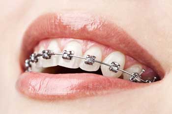 MetalBraces